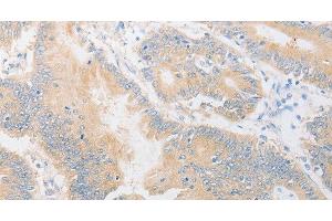 Immunohistochemistry of paraffin-embedded Human colon cancer using CD24 Polyclonal Antibody at dilution of 1:40 (CD24 Antikörper)