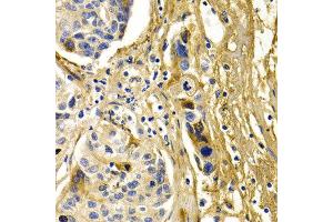 Immunohistochemistry of paraffin-embedded human liver cancer using CFH antibody at dilution of 1:200 (400x lens). (Complement Factor H Antikörper)