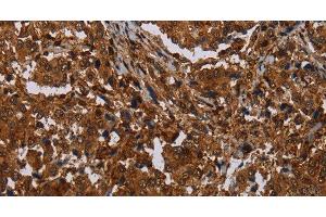 Immunohistochemistry of paraffin-embedded Human liver cancer tissue using MAGEB18 Polyclonal Antibody at dilution 1:30 (MAGEB18 Antikörper)