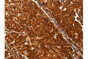 The image on the left is immunohistochemistry of paraffin-embedded Human gastric cancer tissue using ABIN7190469(DHH Antibody) at dilution 1/25, on the right is treated with synthetic peptide. (desert Hedgehog Antikörper)