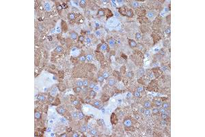 Immunohistochemistry of paraffin-embedded human liver cancer using L1 Rabbit mAb (ABIN7265535) at dilution of 1:100 (40x lens). (ALDH1L1 Antikörper)