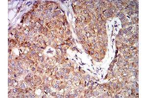 Immunohistochemical analysis of paraffin-embedded bladder cancer tissues using EIF5 mouse mAb with DAB staining. (EIF5 Antikörper  (AA 1-300))