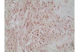 Immunohistochemistry analysis of human melanoma skin tissue using Melanoma marker (human) mAb (HMB45), (ABIN7211713) at a dilution of 1:20. (Melanoma Marker Antikörper)
