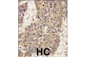 Formalin-fixed and paraffin-embedded human hepatocarcinoma tissue reacted with CASP6 antibody (C-term), which was peroxidase-conjugated to the secondary antibody, followed by DAB staining.