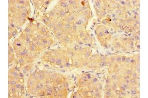 Immunohistochemistry of paraffin-embedded human liver cancer using ABIN7175166 at dilution of 1:100