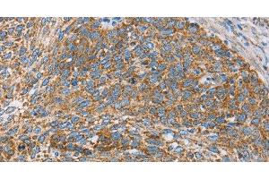 Immunohistochemistry of paraffin-embedded Human cervical cancer tissue using CENPO Polyclonal Antibody at dilution 1:40 (CENPO Antikörper)