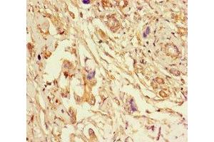 Immunohistochemistry of paraffin-embedded human pancreatic cancer using ABIN7151998 at dilution of 1:100 (ERLIN2 Antikörper  (AA 25-206))