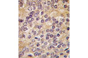 Formalin-fixed and paraffin-embedded human prostata carcinoma tissue reacted with PLAU antibody (C-term ), which was peroxidase-conjugated to the secondary antibody, followed by DAB staining. (PLAU Antikörper  (C-Term))