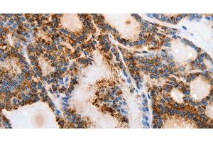 Immunohistochemistry of paraffin-embedded Human thyroid cancer tissue using MUC6 Polyclonal Antibody at dilution 1:40 (MUC6 Antikörper)