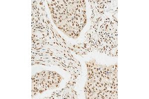 C staining HS in human lung adenocarcinoma tissue sections by Immunohistochemistry (IHC-P - paraformaldehyde-fixed, paraffin-embedded sections). (HSPA7 Antikörper  (AA 169-196))