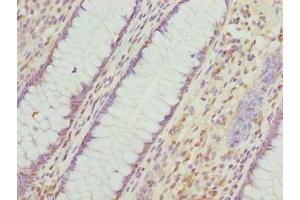 Immunohistochemistry of paraffin-embedded human colon cancer using ABIN7156409 at dilution of 1:100 (Integrator Complex Subunit 14 (INTS14) (AA 231-518) Antikörper)