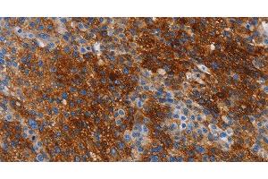 Immunohistochemistry of paraffin-embedded Human liver cancer tissue using CA9 Polyclonal Antibody at dilution 1:50 (CA9 Antikörper)