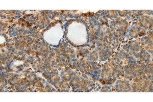 Immunohistochemistry of paraffin-embedded Human thyroid cancer using SULT1E1 Polyclonal Antibody at dilution of 1:30 (SULT1E1 Antikörper)
