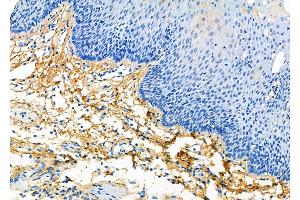 ABIN6260955 and ABIN6266872 at 1/100 staining Human esophageal cancer and adjacent non-tumor tissue by IHC-P.
