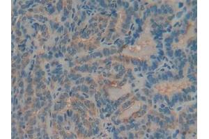 Detection of MUC5AC in Human Thyroid cancer Tissue using Polyclonal Antibody to Mucin 5 Subtype AC (MUC5AC) (MUC5AC Antikörper)