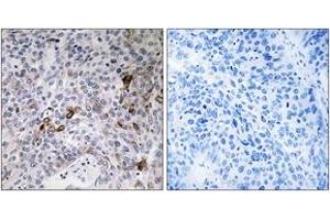 Immunohistochemistry analysis of paraffin-embedded human lung carcinoma tissue, using RAB11FIP3 Antibody. (RAB11FIP3 Antikörper  (AA 569-618))