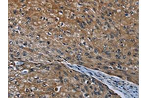 The image on the left is immunohistochemistry of paraffin-embedded Human esophagus cancer tissue using ABIN7190993(HOXC8 Antibody) at dilution 1/20, on the right is treated with synthetic peptide. (HOXC8 Antikörper)