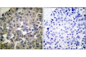Immunohistochemistry analysis of paraffin-embedded human breast carcinoma tissue, using PLCG1 (Ab-771) Antibody. (Phospholipase C gamma 1 Antikörper  (AA 736-785))