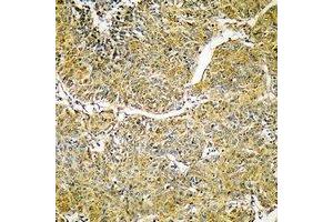 Immunohistochemical analysis of SVOP staining in human liver cancer formalin fixed paraffin embedded tissue section. (SVOP Antikörper)