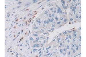Detection of MIB2 in Human Prostate cancer Tissue using Polyclonal Antibody to Mindbomb Homolog 2 (MIB2)