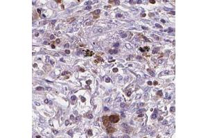 BNIPL Antibody on lung cancer by IHC. (BNIPL Antikörper)