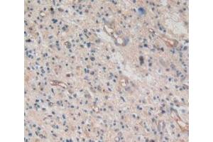 Detection of AREG in Human Glioma Tissue using Monoclonal Antibody to Amphiregulin (AREG) (Amphiregulin Antikörper  (AA 20-100))