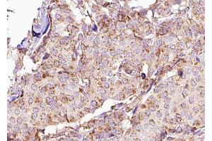ABIN6267668 at 1/100 staining Human breast cancer tissue by IHC-P.