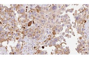 ABIN6274013 at 1/100 staining Human Melanoma tissue by IHC-P. (HAPLN1 Antikörper  (N-Term))