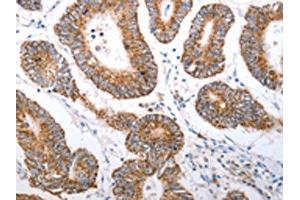 The image on the left is immunohistochemistry of paraffin-embedded Human colon cancer tissue using ABIN7190920(HCRTR1 Antibody) at dilution 1/70, on the right is treated with synthetic peptide. (HCRTR1 Antikörper)
