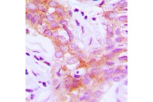 Immunohistochemical analysis of IGF1 Receptor (pY1161) staining in human breast cancer formalin fixed paraffin embedded tissue section. (IGF1R Antikörper  (C-Term, pTyr1161))