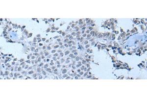 Immunohistochemistry of paraffin-embedded Human ovarian cancer tissue using ZNF703 Polyclonal Antibody at dilution of 1:55(x200) (ZNF703 Antikörper)