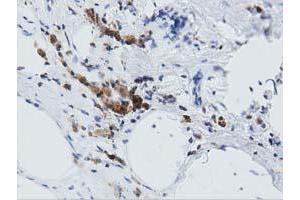 Immunohistochemical staining of paraffin-embedded Carcinoma of Human lung tissue using anti-ARHGAP25 mouse monoclonal antibody. (ARHGAP25 Antikörper)