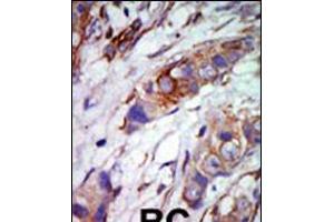 Formalin-fixed and paraffin-embedded human cancer tissue reacted with the primary antibody, which was peroxidase-conjugated to the secondary antibody, followed by AEC staining. (MAPK7 Antikörper  (C-Term))