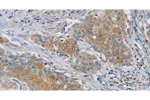 Immunohistochemistry of paraffin-embedded Human ovarian cancer tissue using RASA2 Polyclonal Antibody at dilution 1:45 (RASA2 Antikörper)