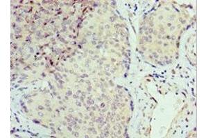 Immunohistochemistry of paraffin-embedded human cervical cancer using ABIN7168869 at dilution of 1:100 (Septin 6 Antikörper  (AA 350-434))