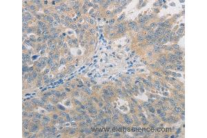 Immunohistochemistry of Human ovarian cancer using GJB6 Polyclonal Antibody at dilution of 1:60
