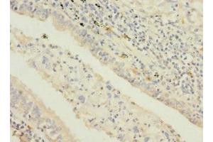 Immunohistochemistry of paraffin-embedded human lung cancer using ABIN7169694 at dilution of 1:100 (STAM2 Antikörper  (AA 376-525))