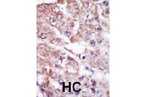 Formalin-fixed and paraffin-embedded human hepatocellular carcinoma tissue reacted with MARK2 polyclonal antibody  , which was peroxidase-conjugated to the secondary antibody, followed by AEC staining. (MARK2 Antikörper  (C-Term))