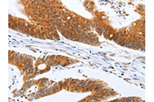 The image on the left is immunohistochemistry of paraffin-embedded Human colon cancer tissue using ABIN7131154(SPATA13 Antibody) at dilution 1/20, on the right is treated with fusion protein. (SPATA13 Antikörper)