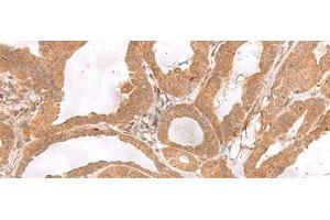 Immunohistochemistry of paraffin-embedded Human thyroid cancer tissue using ETV3 Polyclonal Antibody at dilution of 1:25(x200) (ETV3 Antikörper)