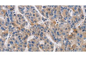Immunohistochemistry of paraffin-embedded Human liver cancer tissue using KLK1 Polyclonal Antibody at dilution 1:40 (Kallikrein 1 Antikörper)