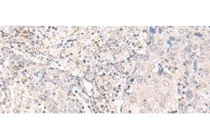 Immunohistochemistry of paraffin-embedded Human cervical cancer tissue using IL12B Polyclonal Antibody at dilution of 1:35(x200) (IL12B Antikörper)