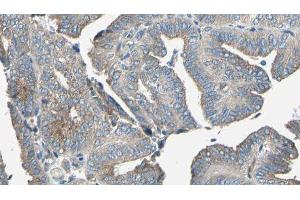 ABIN6277082 at 1/100 staining Human cervical cancer tissue by IHC-P. (TRKA Antikörper  (C-Term))