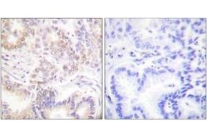 Immunohistochemistry analysis of paraffin-embedded human lung carcinoma tissue, using SENP5 Antibody. (SENP5 Antikörper  (AA 651-700))