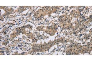 Immunohistochemistry of paraffin-embedded Human gastric cancer tissue using DSG2 Polyclonal Antibody at dilution 1:50 (Desmoglein 2 Antikörper)