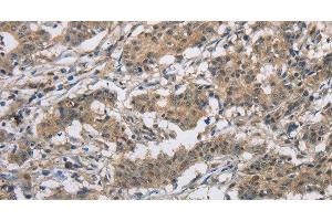 Immunohistochemistry of paraffin-embedded Human gastric cancer tissue using DSG2 Polyclonal Antibody at dilution 1:50