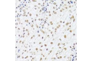 Immunohistochemistry of paraffin-embedded human kidney cancer using DDB1 Antibody. (DDB1 Antikörper)