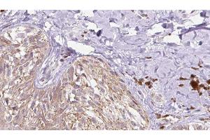 ABIN6279754 at 1/100 staining Human Melanoma tissue by IHC-P. (Reelin Antikörper  (N-Term))