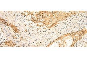 Immunohistochemistry of paraffin-embedded Human esophagus cancer tissue using EEF1AKMT2 Polyclonal Antibody at dilution of 1:50(x200) (METTL10 Antikörper)