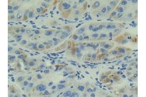 Detection of ADM in Human Liver cancer Tissue using Polyclonal Antibody to Adrenomedullin (ADM)